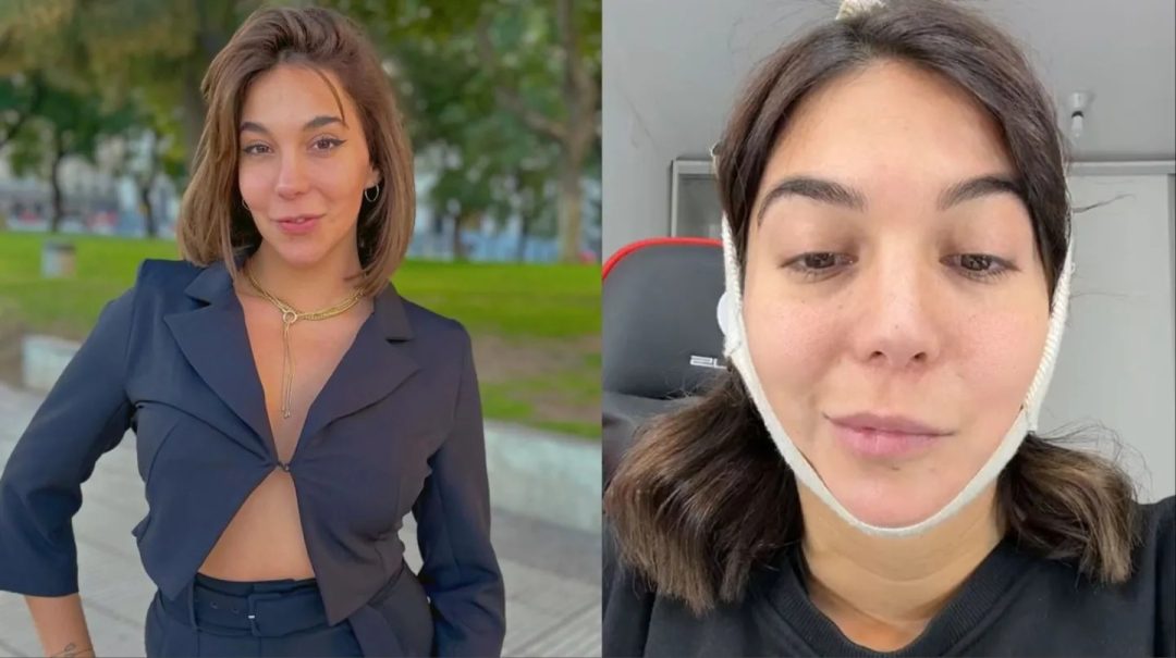 Luciana Milessi se hizo cuatro operaciones y ahora tiene parálisis facial: “Me dijeron que la saqué barata”